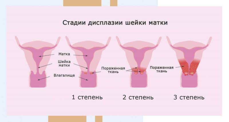 Степени дисплазии шейки матки - 1