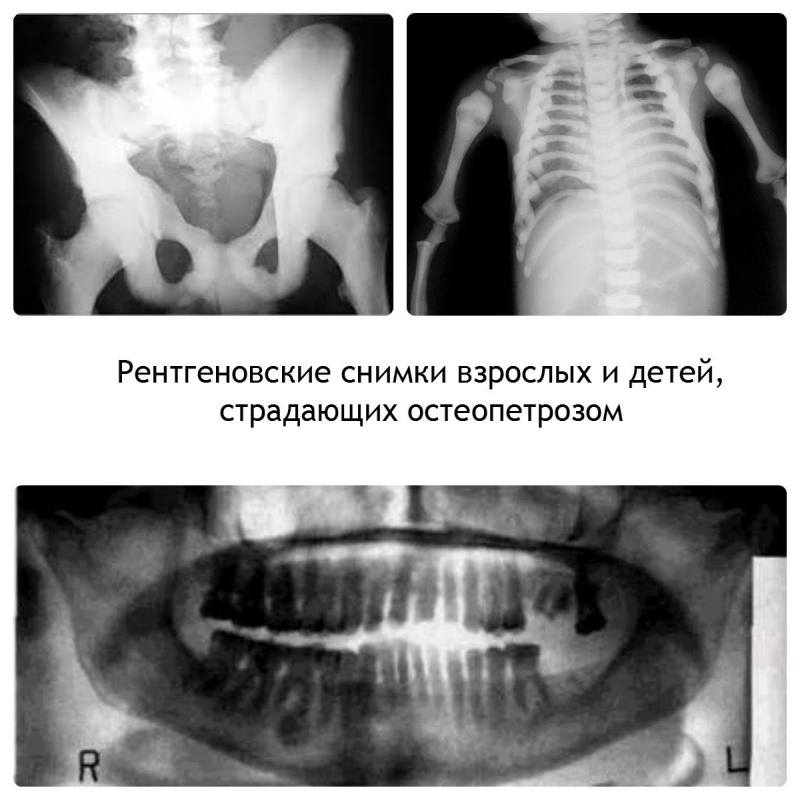Рентгеновские снимки мраморной болезни