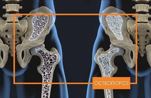 Главные признаки остеопороза
