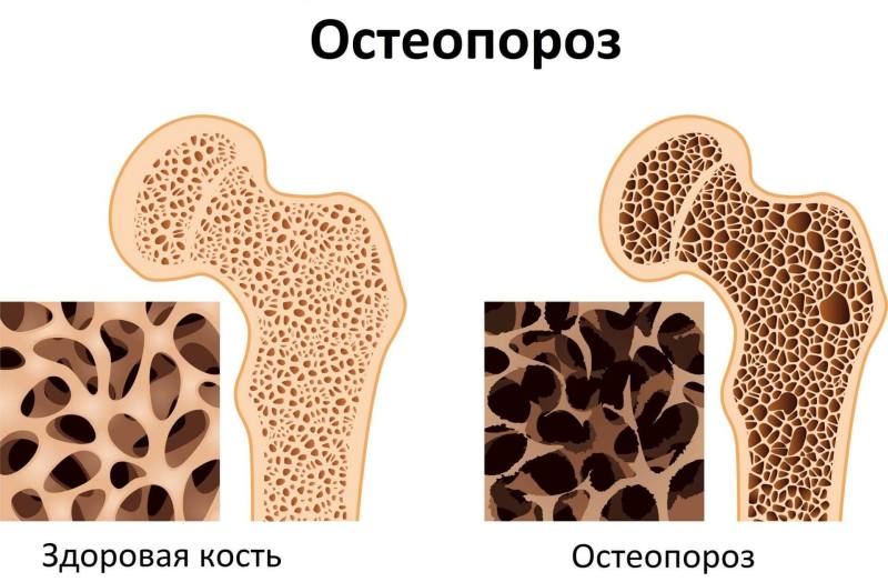 Пример изменения структуры костной ткани при остеопорозе