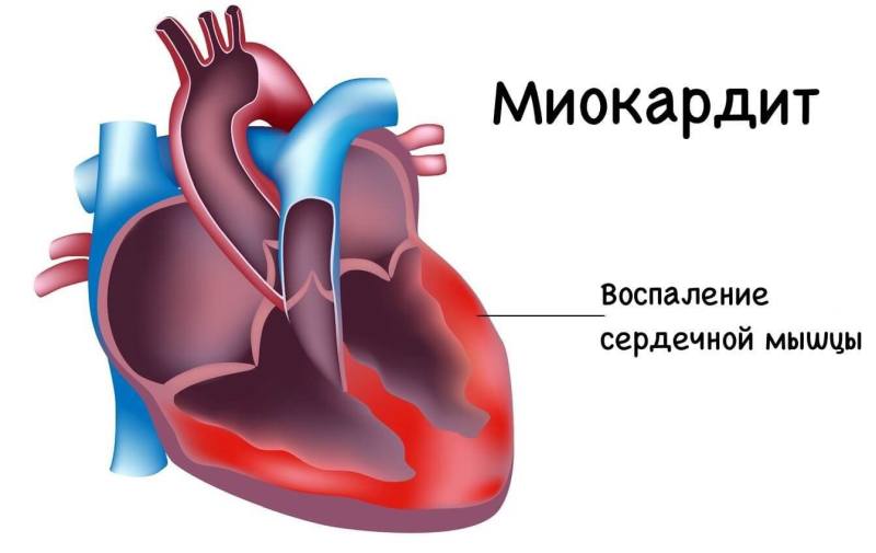 Миокардит: строение сердца