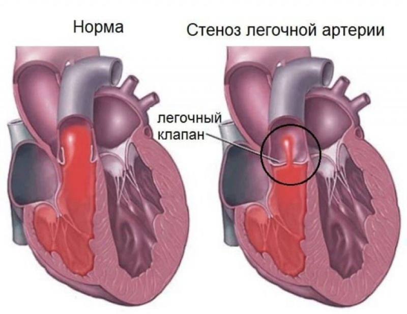 Отличия строения сердца при нормальном развитии и при аплазии