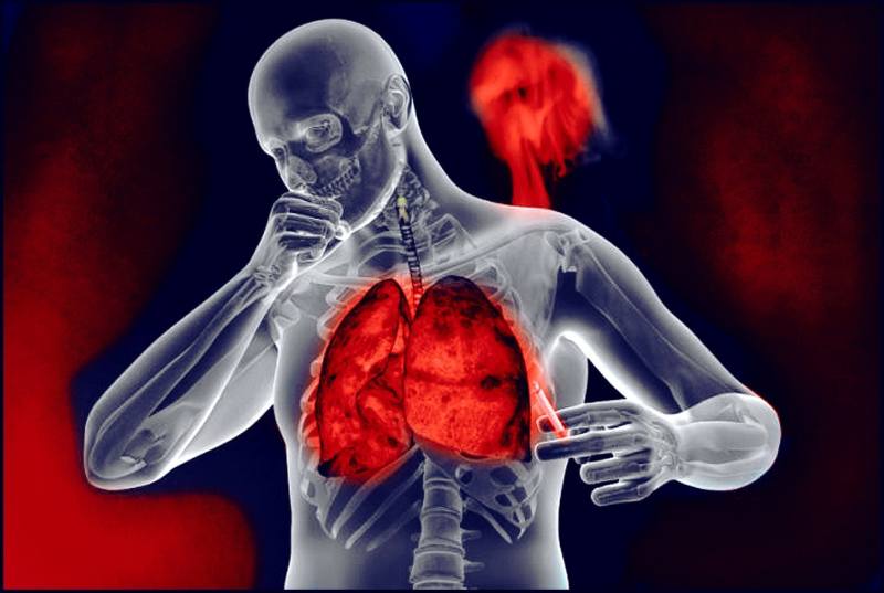 Биссиноз и другие «профессиональные» заболевания дыхательной системы
