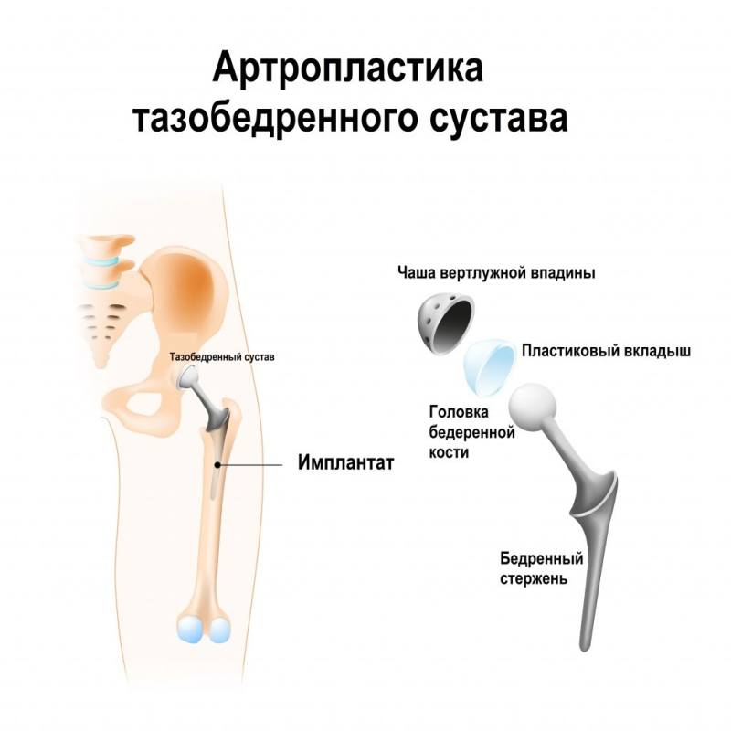 Артропластика тазобедренного сустава