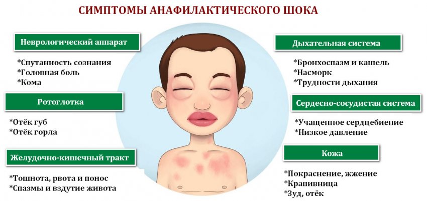 Основные симптомы аллергического отека Квинке
