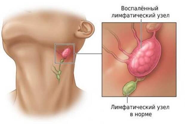 Воспаление лимфоузлов на шее - лечение