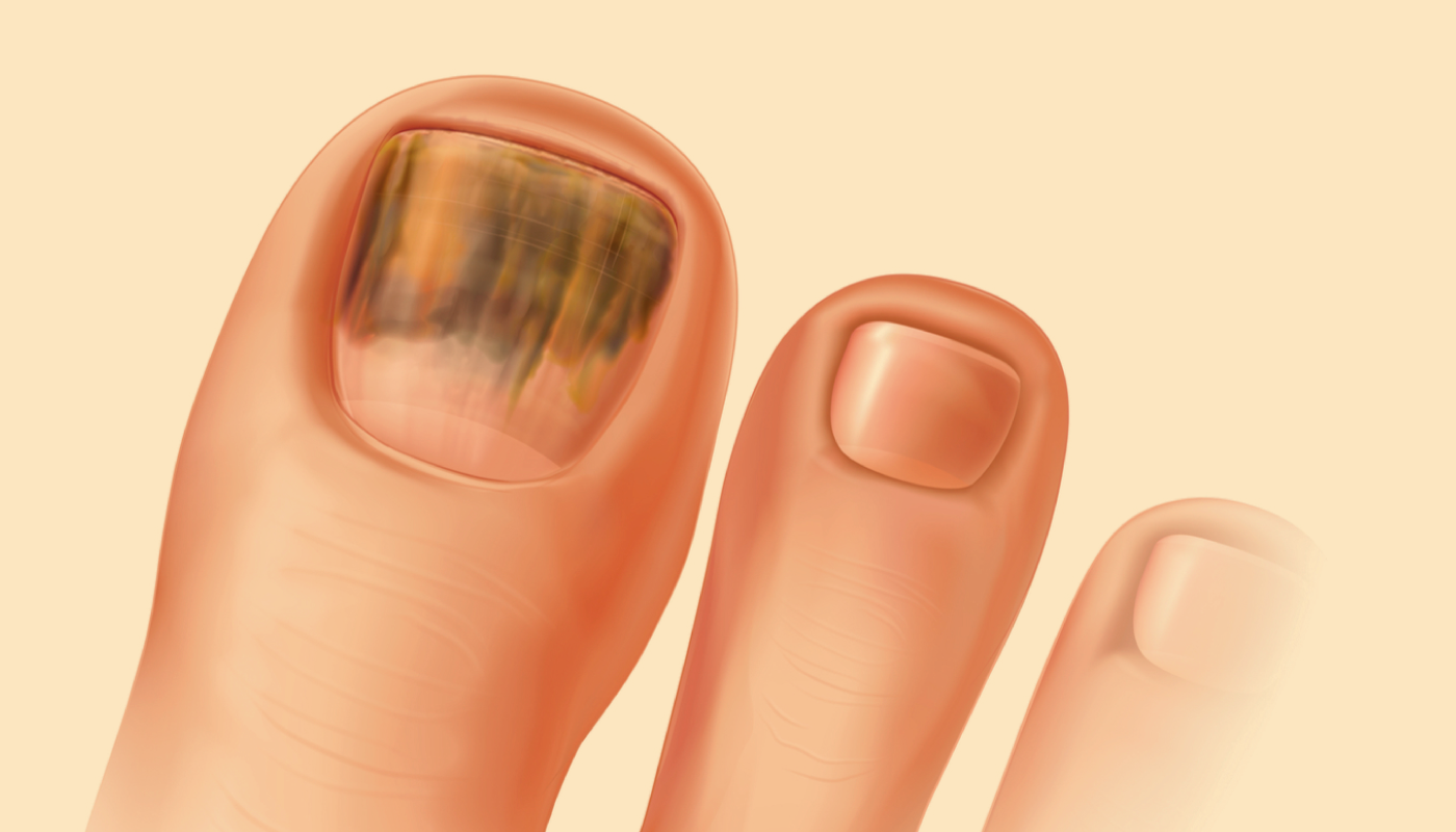 Препараты от грибка на ногтях: какие выбрать?