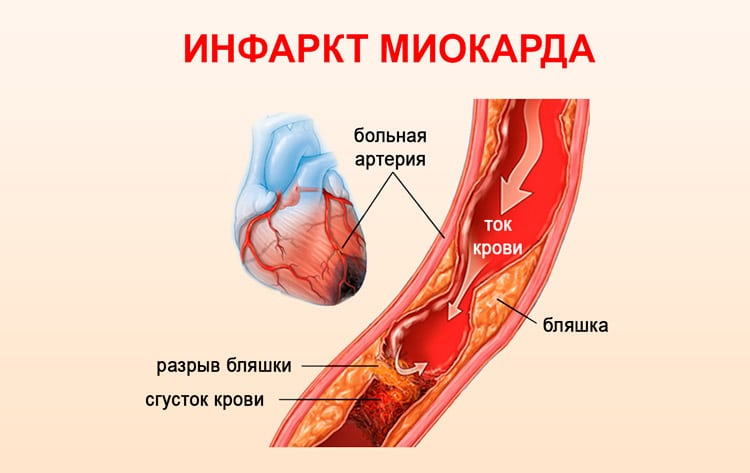 Инфаркт миокарда - 1