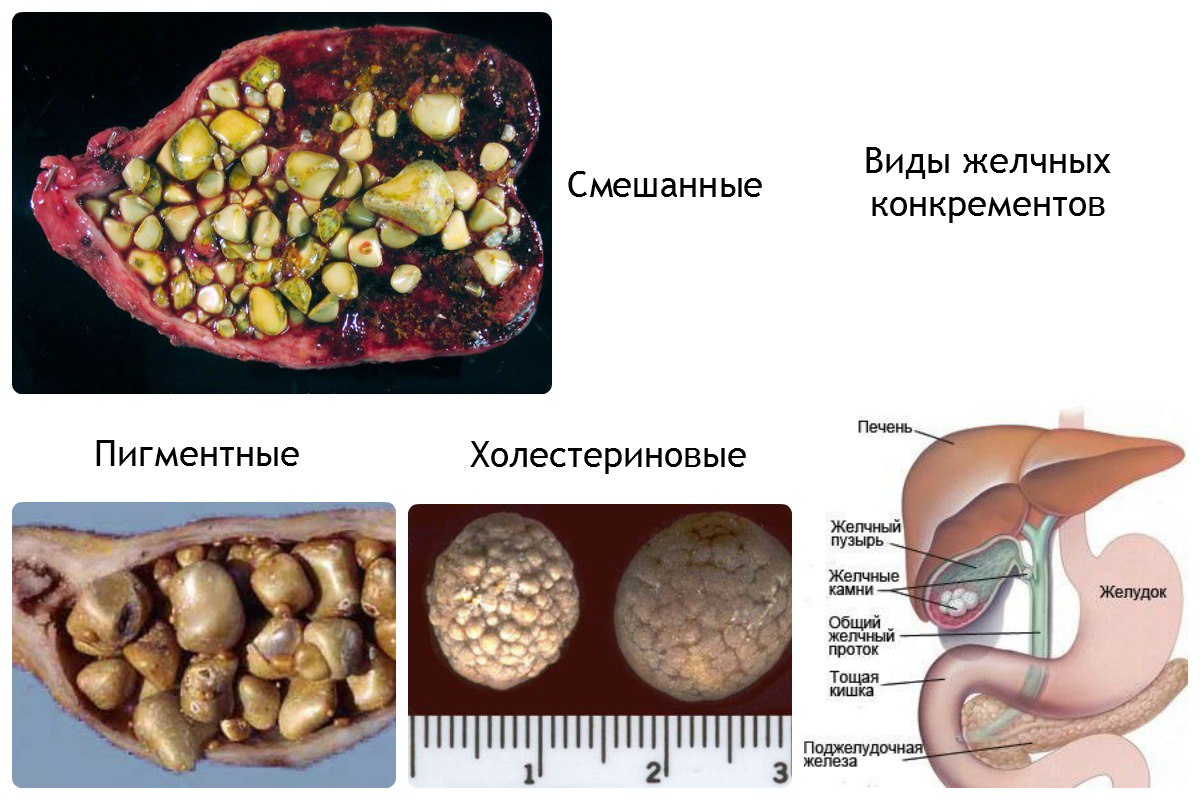 Камни в желчном пузыре: определение, причины, симптомы, диагностика и диета