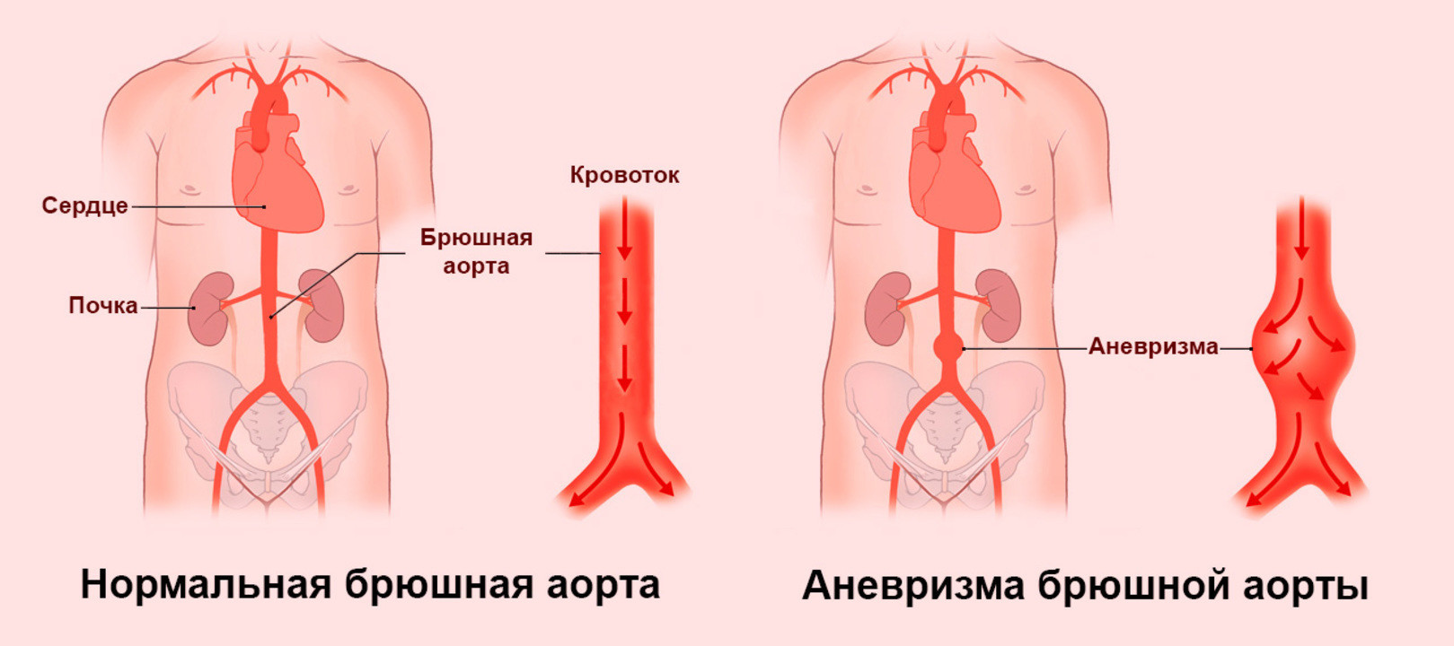 Аневризма аорты: определение, причины, осложнения и лечение
