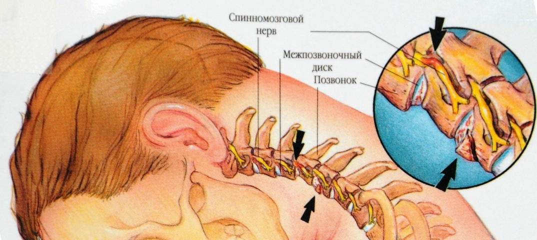Невралгия затылочного нерва: основные причины, симптомы и лечение