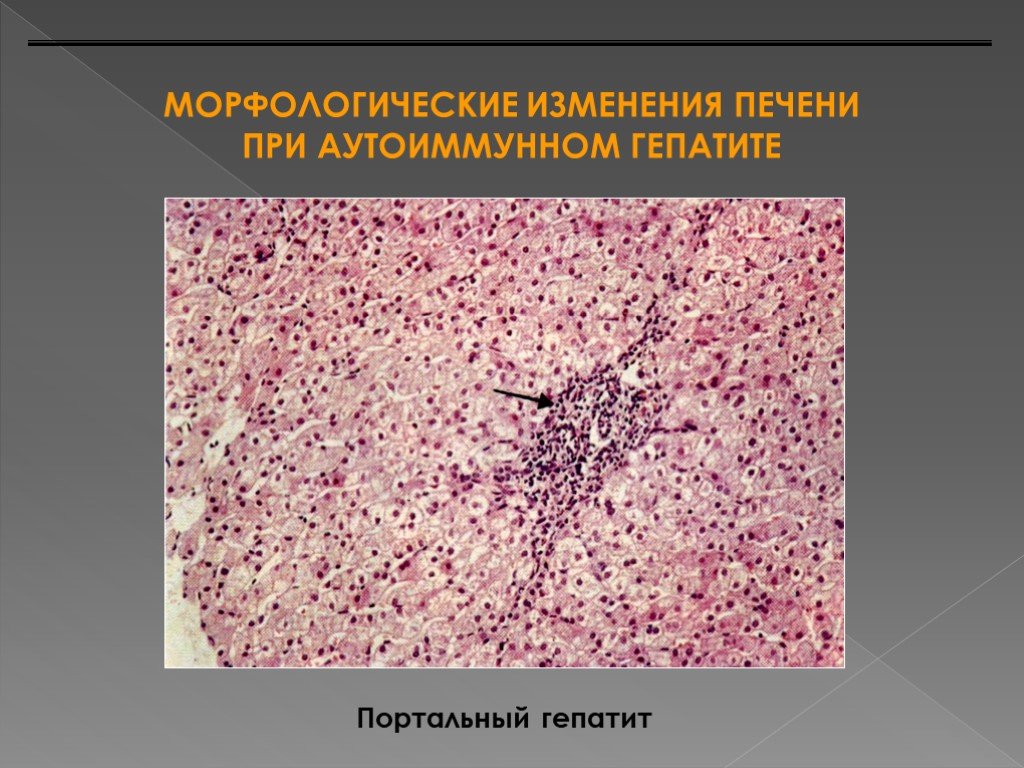 Аутоиммунный гепатит